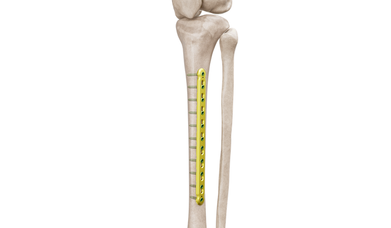 4.5 mm Tibia Düz Plak