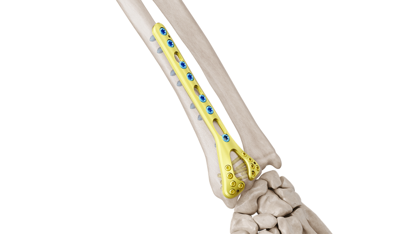 Distal Radyus Dorsal Anatomik Plak