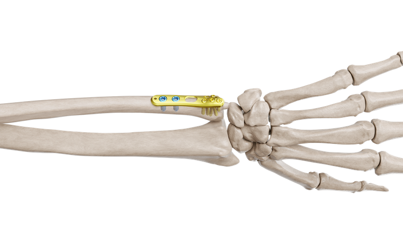 Distal Ulna Anatomik Plak