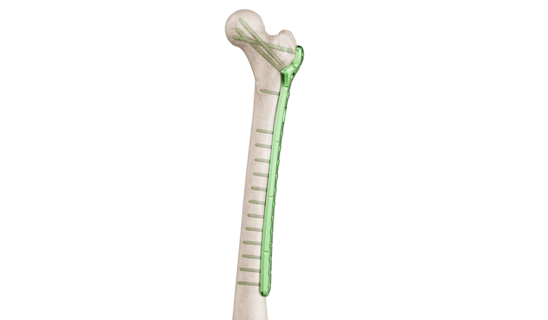 Proximal Femur Lateral Anatomic Plate